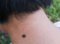 ホクロに生えた毛が太くて濃い理由に関する雑学